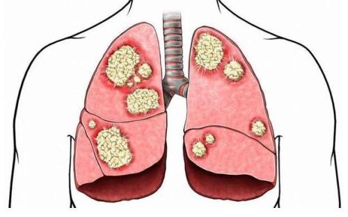 郑州御和堂中医肿瘤中医：肺癌治疗方法有哪些？