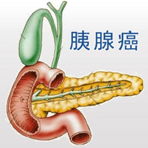 郑州治疗胰腺癌去哪家医馆