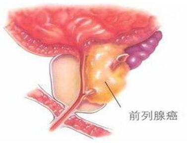 郑州御和堂:前列腺肿瘤中医治疗哪家好