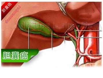 胆囊癌晚期症状