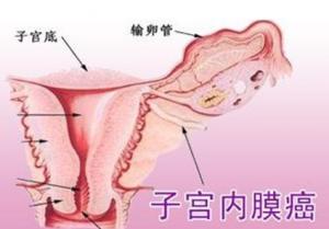 郑州御和堂：子宫内膜癌能活多久？