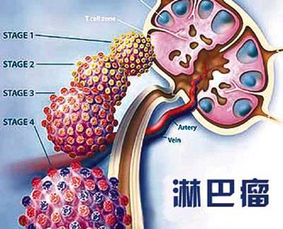 郑州御和堂中医肿瘤中医：那些不可忽视的淋巴瘤症状