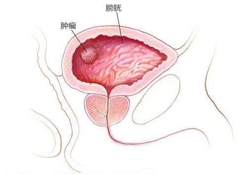 郑州御和堂中医肿瘤中医：容易得膀胱癌的患者有哪些